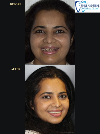 Smile Makeover Result 1