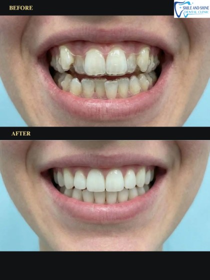 Smile Makeover Result 2