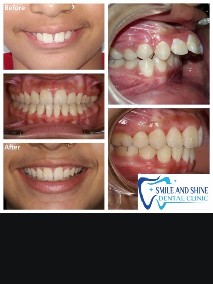 Smile Makeover Result 3