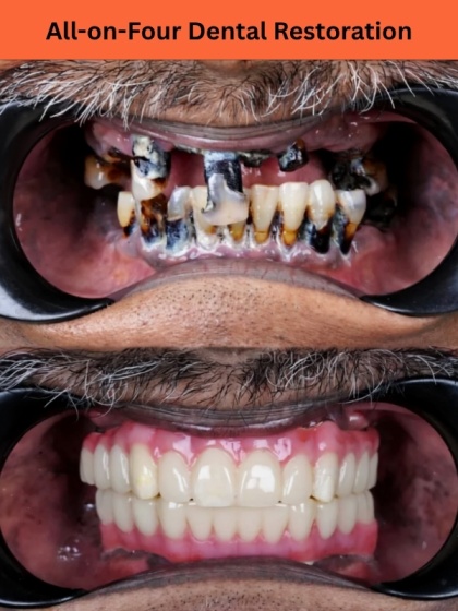 Implant Result 1